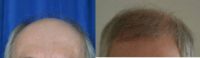 55-64 year old man treated with Artas Robotic Hair Transplant