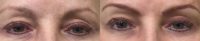 Woman treated with Microblading