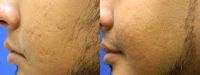 18-24 year old man treated with Acne Scars Treatment