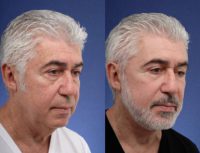 64 year old man treated with Facial Rejuvenation