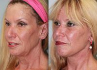 55 Year Old Female -- Lower Face and Neck Lift