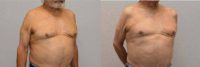 75 and up year old man treated with BodyTite