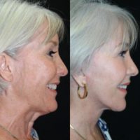 65-74 year old woman treated with Lower Facelift