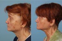 65-74 year old woman treated with Laser Resurfacing