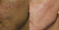 Acne scar treatment,  Laser resurfacing,  Scar revision