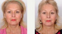 Face And Neck Lift, Upper And Lower Eyelid Lift And Endoscopic Brow Lift. Before With Dr. William H. Sabbagh, MD, Detroit Plastic Surgeon