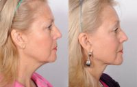 Face and neck lift, Upper and Lower eyelid lift and endoscopic brow lift.