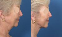 Facelift and Necklift Surgery