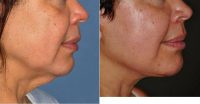 Facelift Before By Dr Barry L. Eppley, MD, DMD, Indianapolis Plastic Surgeon