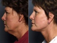 Facelift Before By Dr. Adam D. Stein, MD, Raleigh-Durham Facial Plastic Surgeon