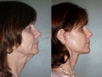 Facelift Before By Dr. David C. Mabrie, MD, Bay Area Facial Plastic Surgeon