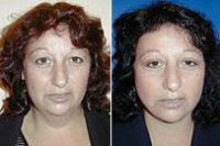 Facelift Before By Dr. Paul Wigoda, MD, Fort Lauderdale Plastic Surgeon