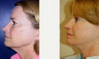 Facelift Before By Dr. Timothy Fee, MD, Jacksonville Plastic Surgeon