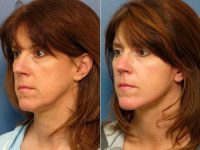 Facelift Before With Doctor Adam D. Stein, MD, Raleigh-Durham Facial Plastic Surgeon