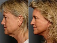 Facelift Before With Doctor Adam D. Stein, MD, Raleigh-Durham Facial Plastic Surgeon 595