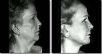 Facelift Before With Doctor Z. Paul Lorenc, MD, Manhattan Plastic Surgeon