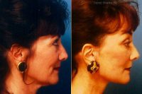 Facelift, Endoscopic Browlift, Upper And Lower Blepharoplasty Before By Dr. Daniel Shapiro, MD, Scottsdale Plastic Surgeon