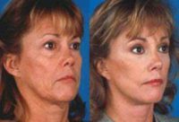 Facelift, eyelid surgery, neck & brow lift