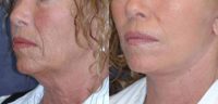 Facelift, TCA peel and perioral dermabrasion