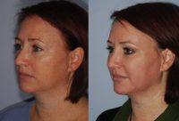 Facial Rejuvenation with Fat Transfer and CO2 laser resurfacing