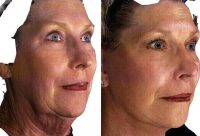 Female Treated For Skin Laxity And Aging Before By Dr. Farhan Taghizadeh, MD, Phoenix Facial Plastic Surgeon