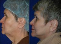 Woman treated with Neck Lift