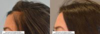 Forehead Reduction/Hairline Lowering with Hair transplantation