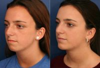 Woman treated with Cervicoplasty and Chin Implant