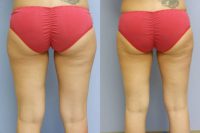 Laser Lipo on Outer Thighs