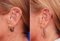 Left Ear Skin Cancer Excision and Reconstruction