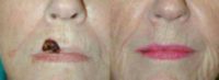 Lip skin cancer reconstruction