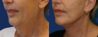 Lower Facelift and Necklift with Platysmaplasty