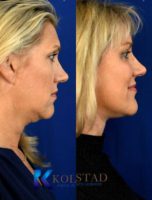 Lower Face and Neck Lift with Facial Fat Transfer