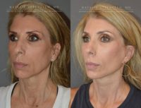 Lower Facelift and Necklift