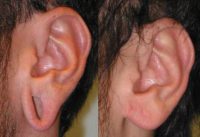 Man treated with Ear Lobe Surgery