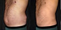 Man treated with Liposuction