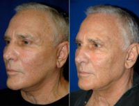 Man treated with Neck Lift