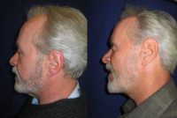 Man treated with Neck Lift