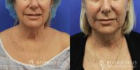 Woman treated with FaceTite