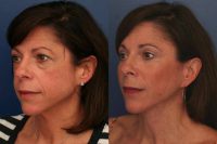 Patient treated with Facelift