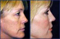 Blepharoplasty and Fat transfer