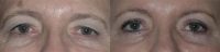 Blepharoplasty (eyelids)