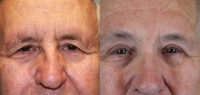 Procedure: Forehead Lift and Upper Eyelid Surgery