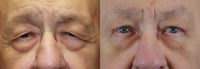 Procedure: Forehead Lift and Upper Eyelid Surgery