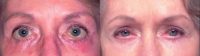 Repair of bad eyelid surgery