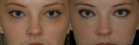 Restylane injected under the eyes