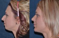 Rhinoplasty and chin implant