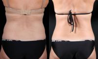 Slimmer Hips and Waist With No Surgery