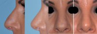 This woman underwent a revisional rhinoplasty.