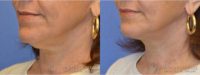 This woman underwent a revision neck lift under local injection anesthesia.